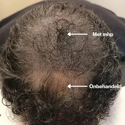 Behandeld en onbehandeld MHP