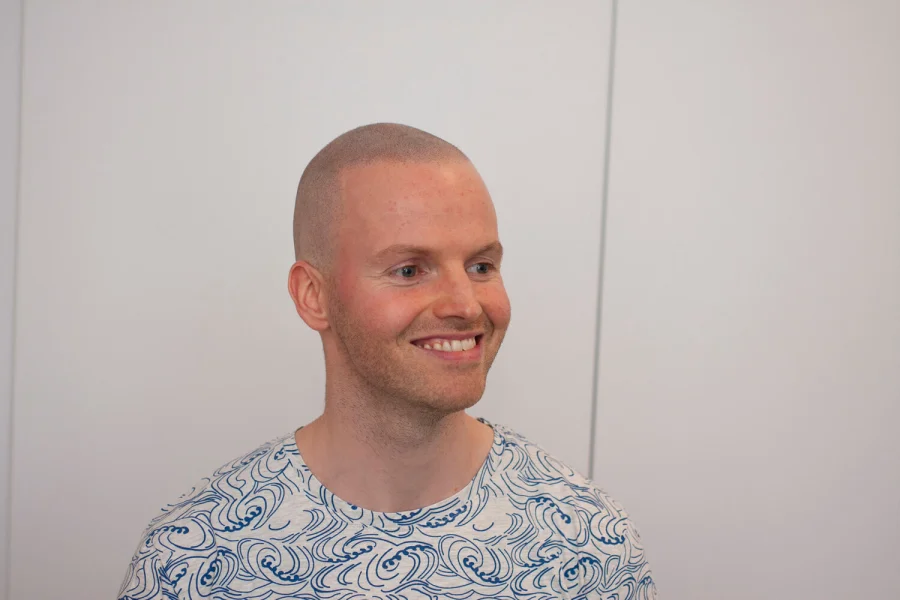 Alopecia behandeling bij mannen