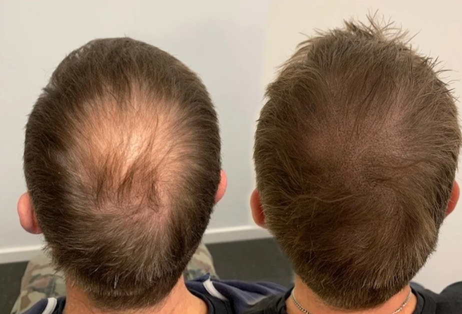 Micro haar pigmentatie bij lang haar