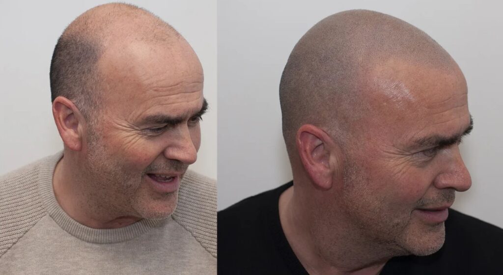 micro-haar-pigmentatie-frontpage