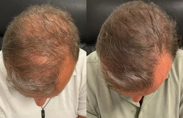 mhp-wat-is-Micro-Haar-Pigmentatie