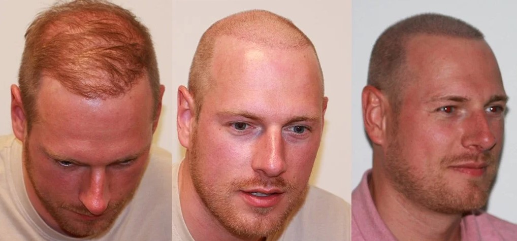 Micro Haar Pigmentatie na Haartransplantatie