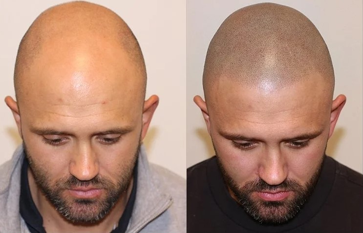 microhaarpigmentatie-wat-is-micro-haar-pigmentatie-2