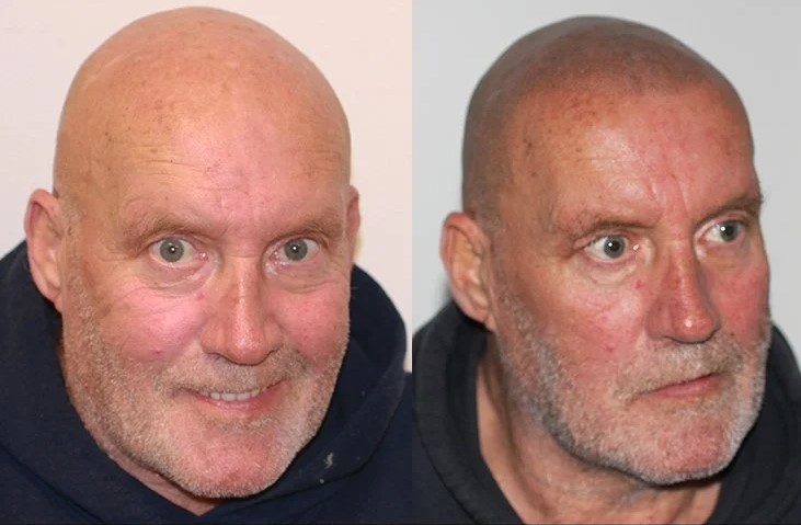 mhp-Zachte-haarlijn-1