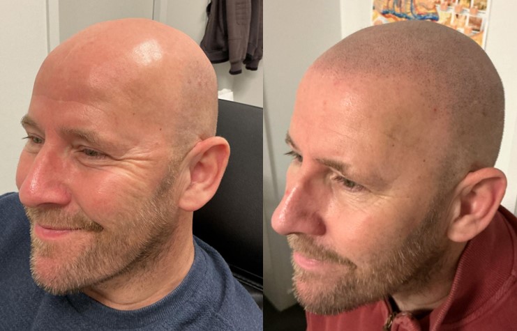 microhaarpigmentatie-wat-is-micro-haar-pigmentatie-1