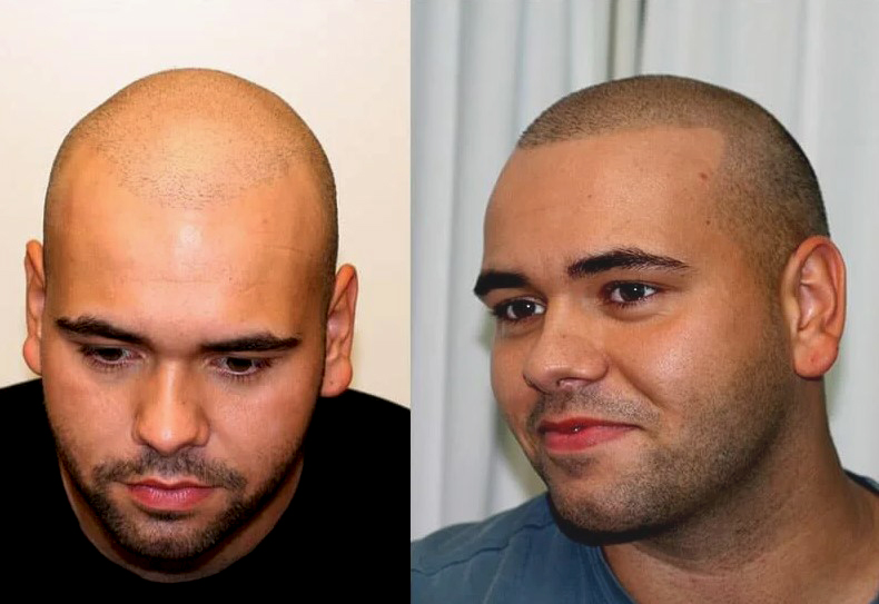 Micro Haar Pigmentatie na Haartransplantatie