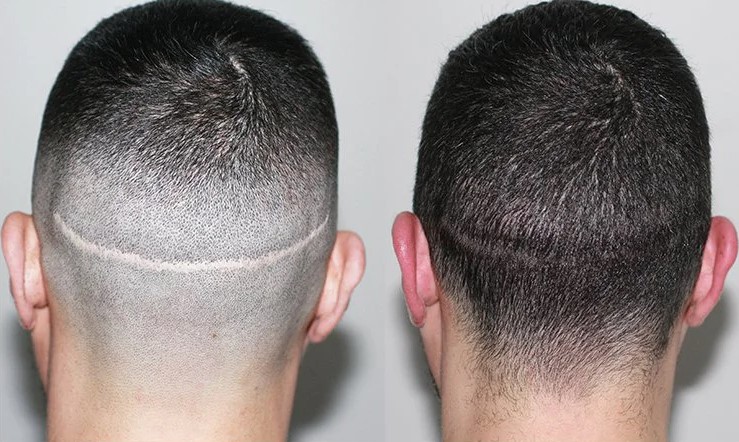 Micro Haar Pigmentatie na Haartransplantatie