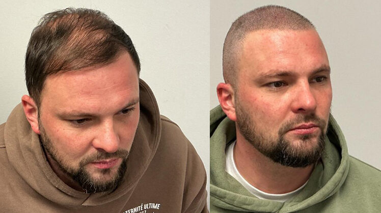 microhaarpigmentatie-wat-is-micro-haar-pigmentatie-6