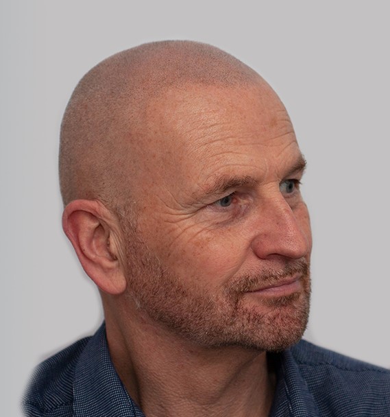 michael-mhp-Zachte-haarlijn