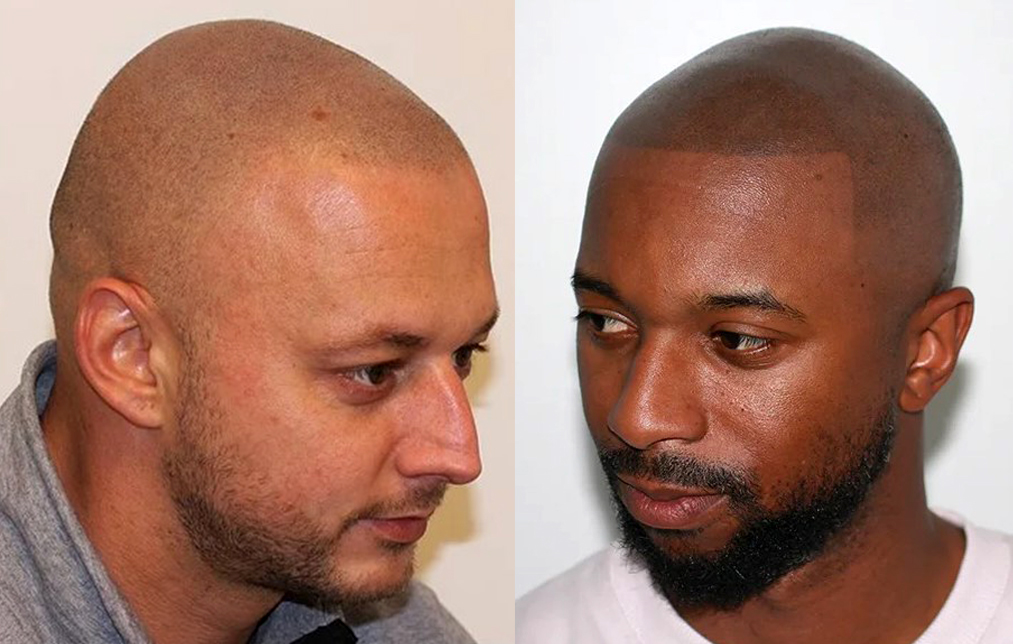 microhaarpigmentatie-wat-is-micro-haar-pigmentatie-4