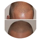 Opvullen tussen eigen haar