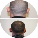 Fut pigmentatie behandeling