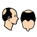 Extra grote kruin + bovenkant hoofd (met eigen haar)