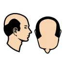 Compleet bovenhoofd (aansluitend op haarkrans)